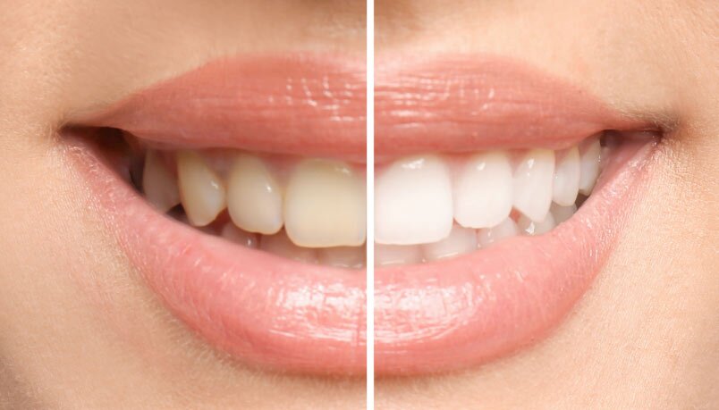 Before and After Teeth Whitening Results